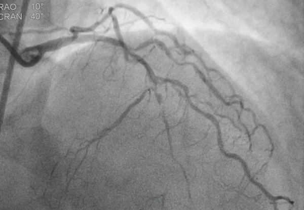 Coronary angiography, Coronary artery disease. Medical x-ray of heart disease. Healthcare and medical concept.