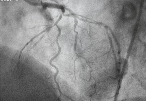 Coronary angiography, Coronary artery disease. Medical x-ray of heart disease. Healthcare and medical concept.