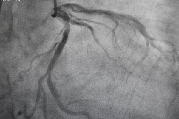 Коронарная ангиография, ишемическая болезнь. Медицинский рентген сердечных заболеваний. Здравоохранение и медицина.