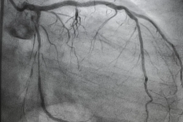 Angiografia Wieńcowa Choroba Wieńcowa Prześwietlenie Medyczne Choroby Serca Opieka Zdrowotna — Zdjęcie stockowe