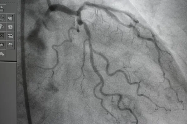 Coronary angiography, Coronary artery disease. Medical x-ray of heart disease. Healthcare and medical concept.