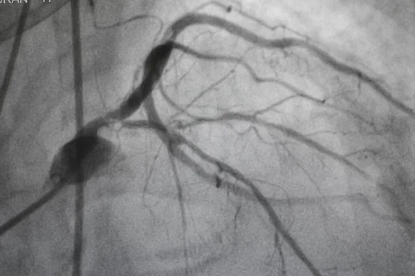 Angiographie Coronarienne Coronaropathie Radiographie Médicale Des Maladies Cardiaques Soins Santé — Photo
