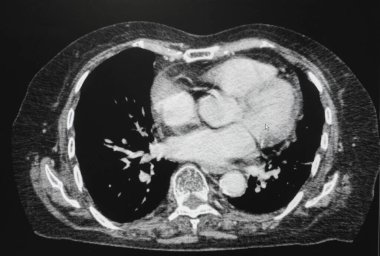 Tomografi Karın Çapraz Görünümü. Göğüs organlarının CT taraması (bilgisayarlı tomografi). 