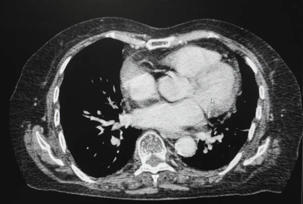 Abdomen横断面视图 胸部器官的Ct扫描 计算机断层扫描 — 图库照片