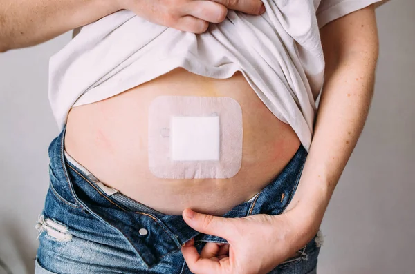 Barriga feminina após uma operação médica. Eliminação da hérnia umbilical. — Fotografia de Stock