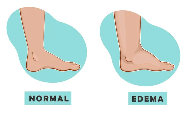 Un piede e una caviglia gonfi e un piede normale. Illustrazione vettoriale — Vettoriale Stock