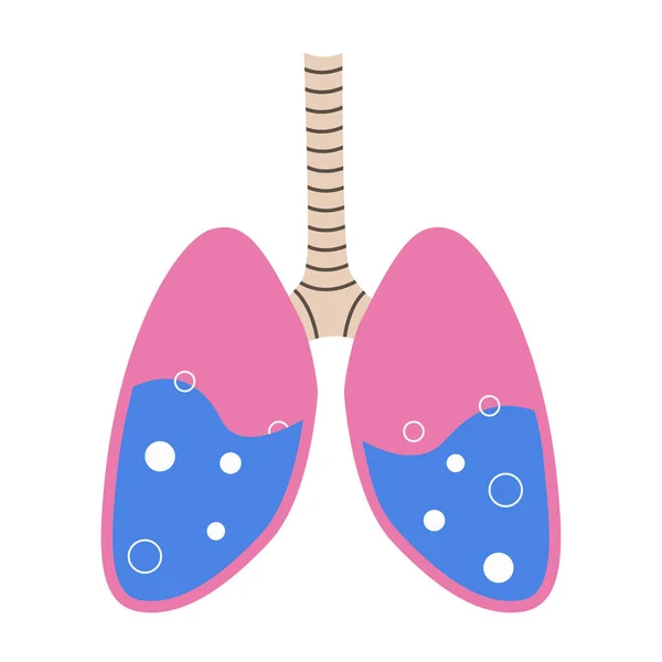 Pulmonary edema. Fluid in the respiratory organs. Bubbles in the lungs. Vector illustration. — Stock Vector