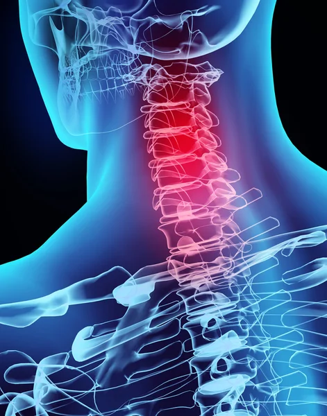 3D illustratie x-ray nek pijnlijk. — Stockfoto