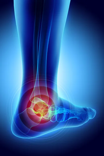 Ankle menyakitkan - skeleton x-ray . — Stok Foto