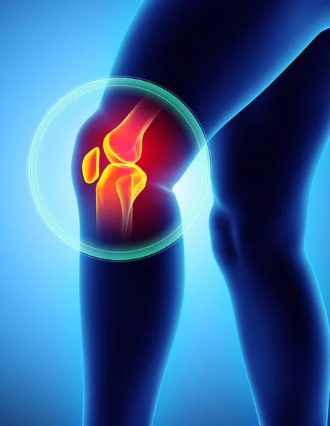 Knie pijnlijke - skelet x-ray. — Stockfoto