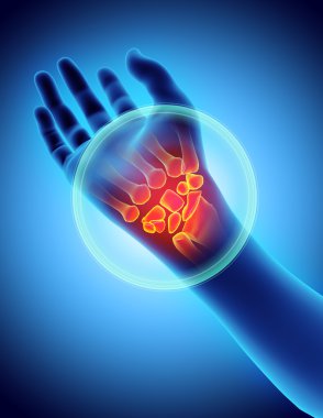 Wrist painful - skeleton x-ray. clipart
