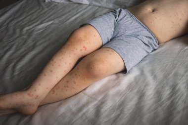 Roseola hastalığı yüzünden kızarıklığı olan küçük bir çocuk. Roseola virüsün yol açtığı bulaşıcı bir hastalıktır.
