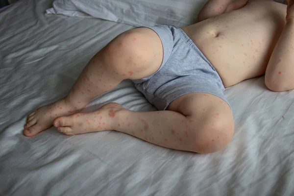 Uma Criança Com Erupção Cutânea Infectada Pela Doença Roseola Roseola — Fotografia de Stock