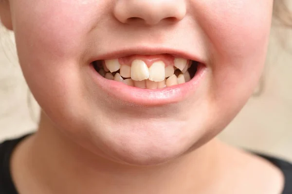 Denti storti in una bambina — Foto Stock