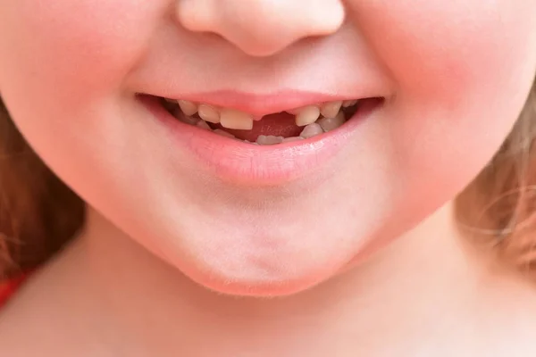Child smile with first baby tooth that has fallen out — Stock Photo, Image