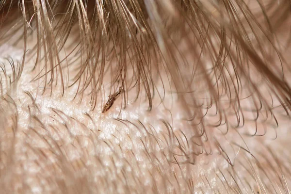 Piolhos mortos em um cabelo infantil após a desinfecção — Fotografia de Stock