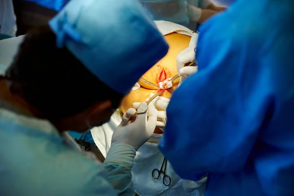 Operation Das Chirurgenteam Wird Eine Entfernung Des Narbengewebes Vornehmen Medizinische — Stockfoto