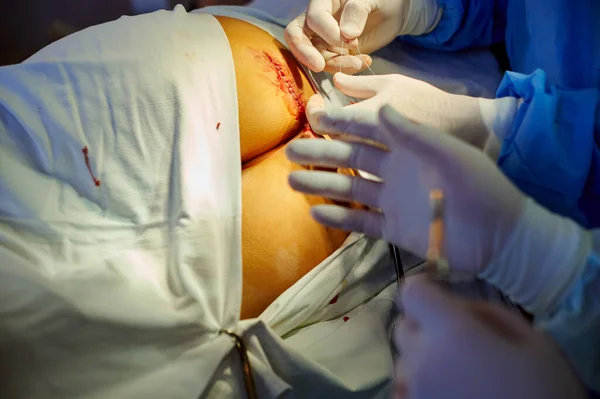 Operation Blick Auf Die Hände Des Chirurgen Der Die Ligatur — Stockfoto