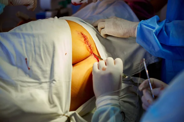 Cirurgia Vista Das Mãos Cirurgião Costurando Ferida — Fotografia de Stock