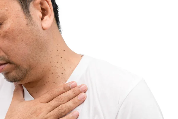 Beyaz arka planda izole edilmiş boyundaki deri etiketleri ya da Acrochordon 'u kapatmış. Sağlık hizmeti kavramı