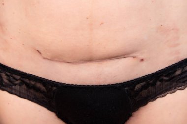 Kız bir yara izi gösteriyor, sezaryen sonrası bir keloid. Hamilelikten ve doğumdan 14 gün sonra karın..
