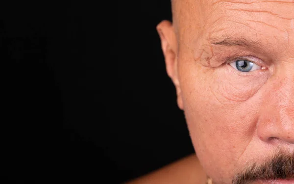 Portrait of a man with a cosmetic eye prosthesis. The consequences of glaucoma. Selective focus.