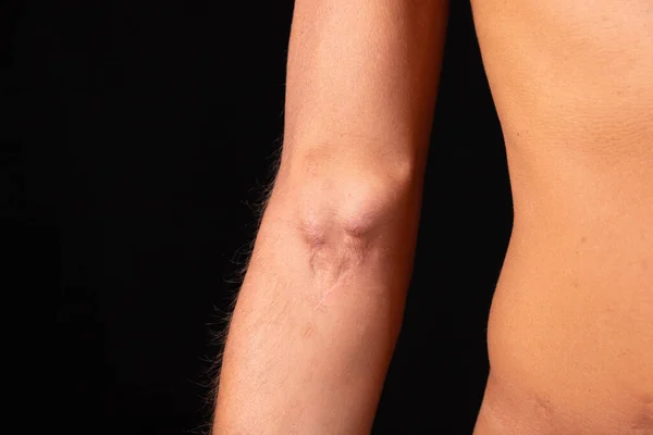 Fistula Arm Als Gevolg Van Een Operatie Voor Hemodialyse Met — Stockfoto