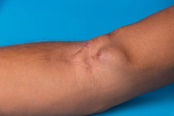 Fistula Arm Als Gevolg Van Een Operatie Voor Hemodialyse Met — Stockfoto