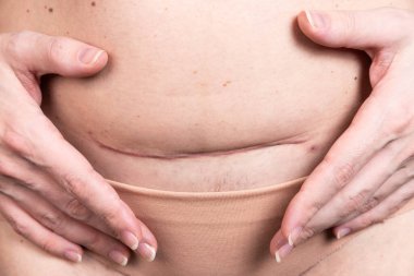 Bir insanın derisinde yara izi, kadın, sezaryen sonrası keloid. Çocuğun doğumundan 30 gün sonra.