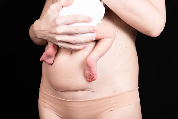 Litteken Huid Van Een Persoon Vrouw Keloïde Keizersnede Dagen Geboorte — Stockfoto