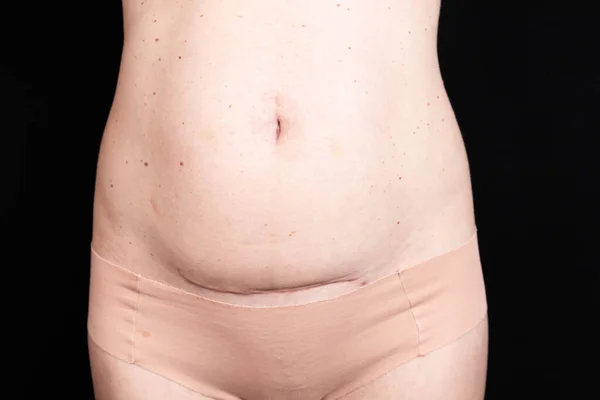 剖宫产后皮肤上的疤痕 分娩后30天内 — 图库照片