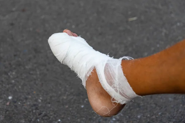 Male foot in a bandage in the foreground. Damage to the foot and fingers, damage to the ligaments of the lower limb, rehabilitation. Medicine and health. Close-up. Side view.