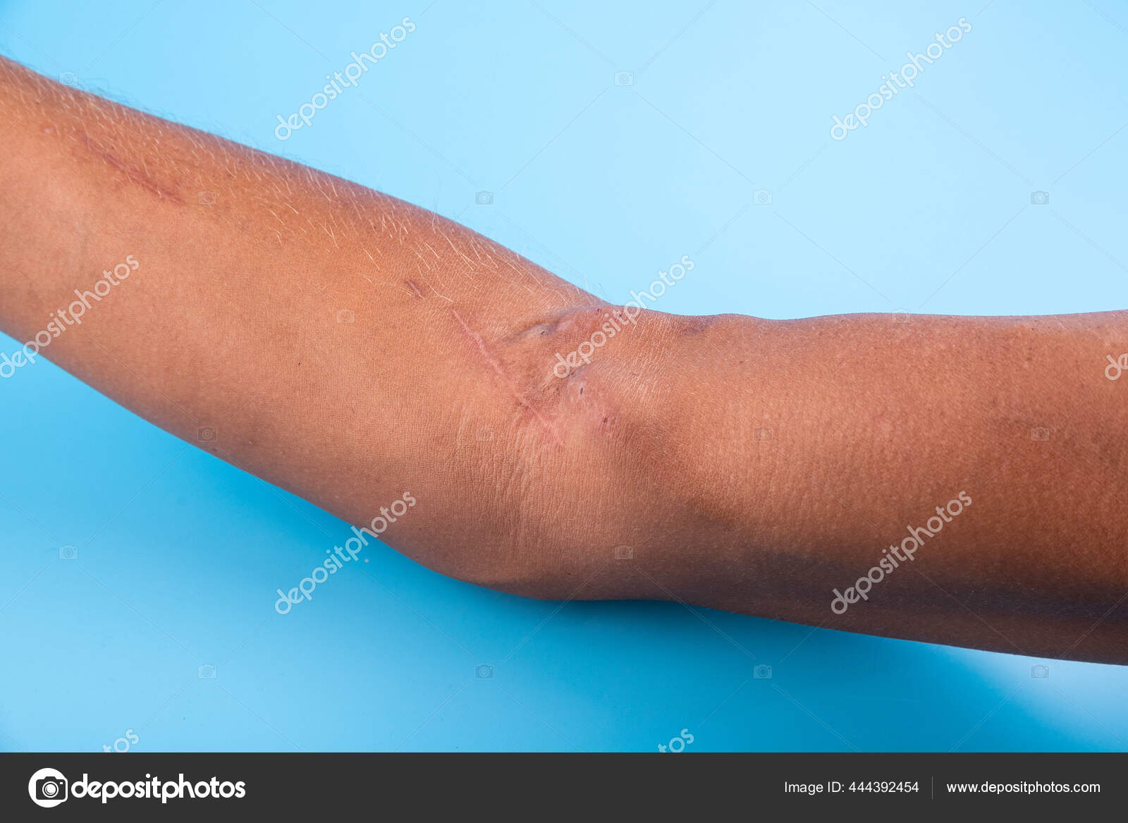 Fistula Arm Result Operation Hemodialysis Kidney Failure Stock Photo by