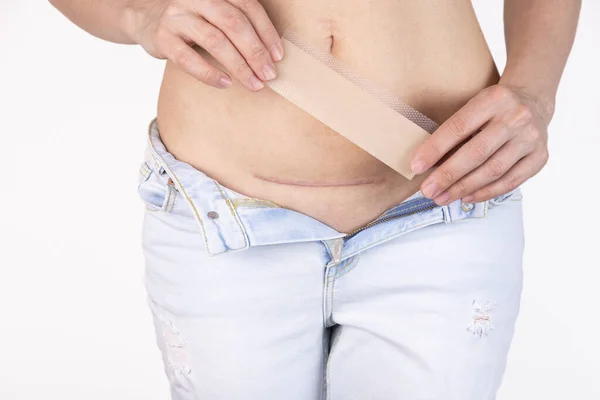 Woman Applying Patch Silicone Sheeting Her Scar Section Surgery Therapy — Stock Photo, Image