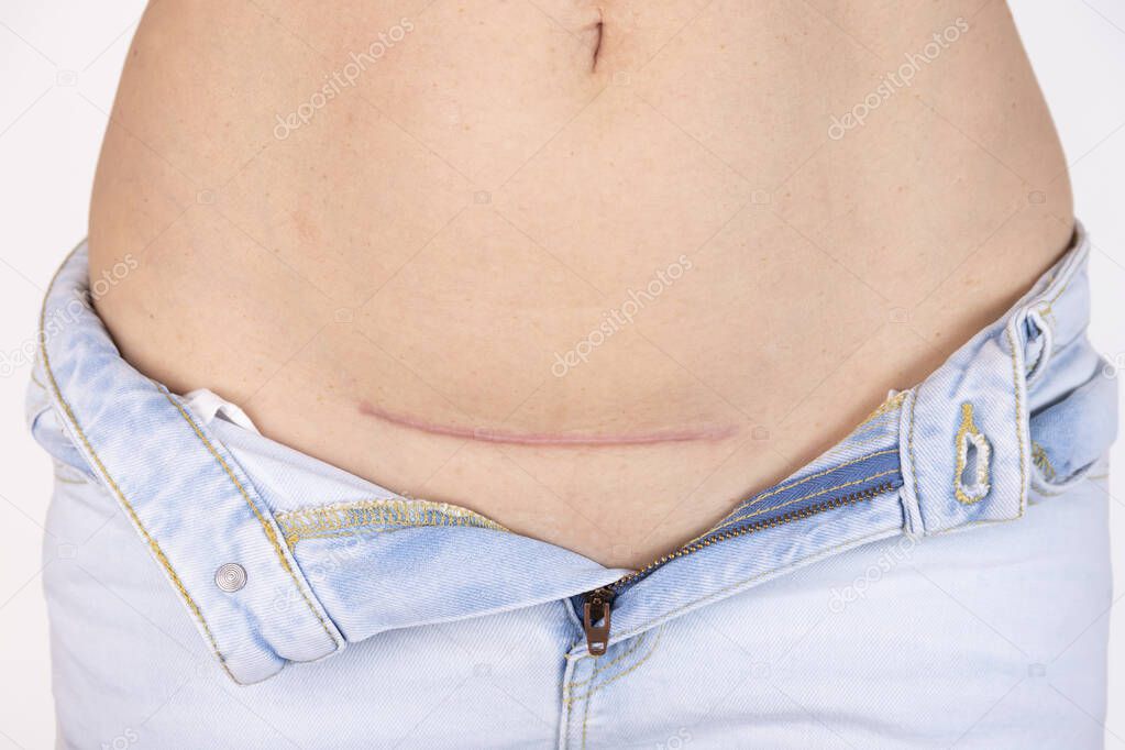 Woman's belly with a scar after cesarean section, childbirth. Five months after surgery.