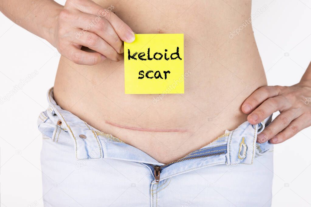 Keloid scar on the girl's body after cesarean section. In her hand is a yellow plaque with the words Keloid scar.