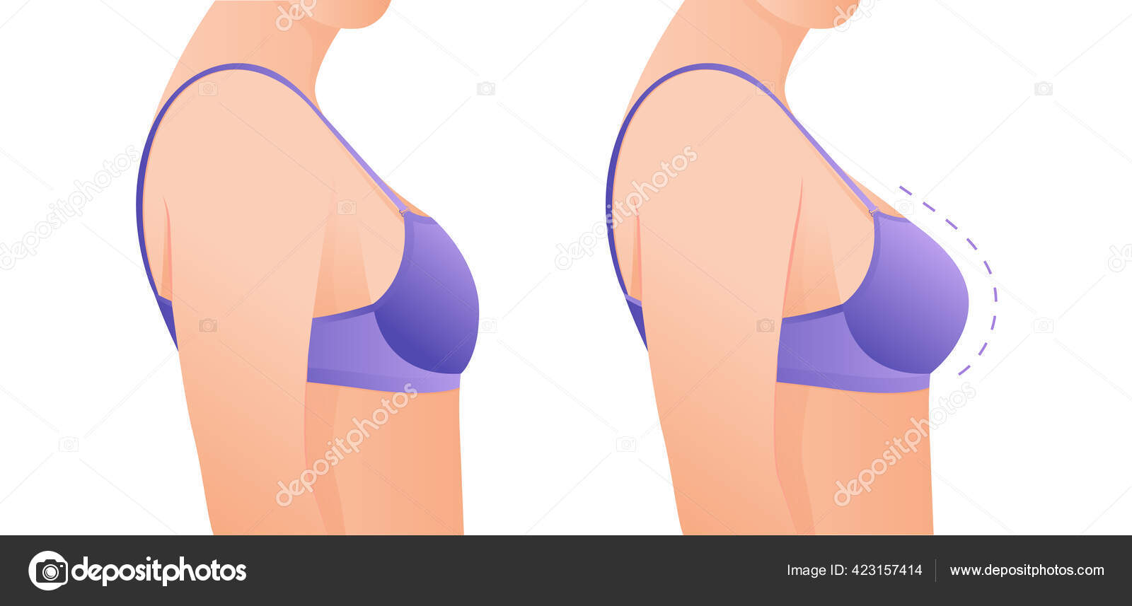 Before and after breast augmentation concept, woman with very large  silicone breasts after correction surgery Stock Photo