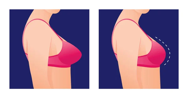 隆乳前后胸罩中的女性乳房尺寸校正 整形手术的概念 由于训练 节食或健身锻炼 女性的身体由超重转为苗条 — 图库矢量图片