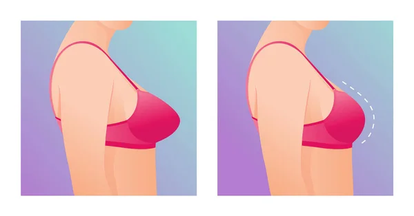 Seins Féminins Soutien Gorge Avant Après Augmentation Correction Taille Des — Image vectorielle