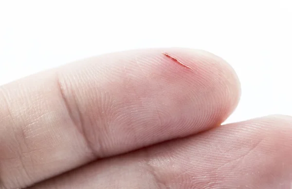 Incision wound on finger on white background — Stock Photo, Image