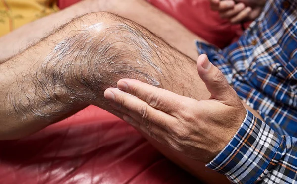 Adam bacağına iltihap önleyici merhem sürüyor. 