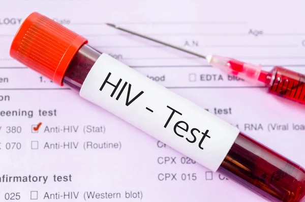 Пробирка для сбора крови с этикеткой для тестирования на ВИЧ . — стоковое фото