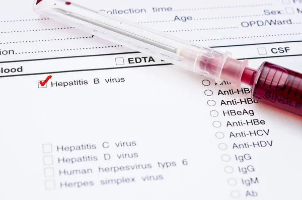 Prueba del virus de la hepatitis B . — Foto de Stock