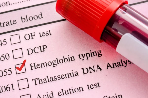 Hemoglobiny pisania testu — Zdjęcie stockowe