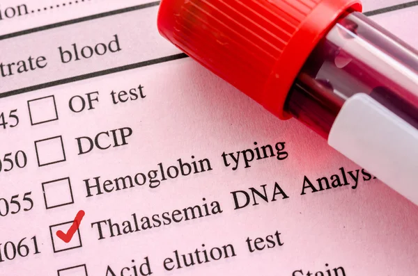 Test del DNA talassemico — Foto Stock