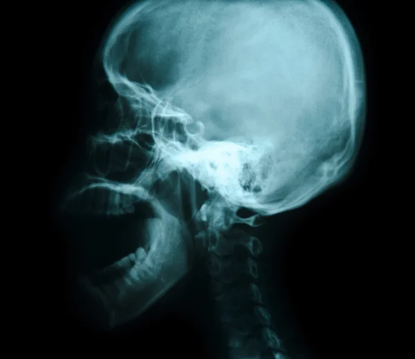 颅骨的 x 光照片 — 图库照片