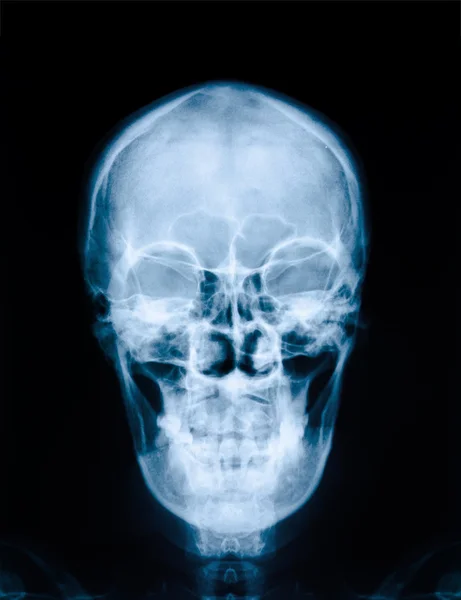 X-ray image ou radiographique de crâne humain, gros plan 
