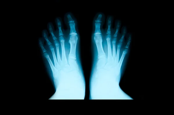 Radiographie du pied . — Photo