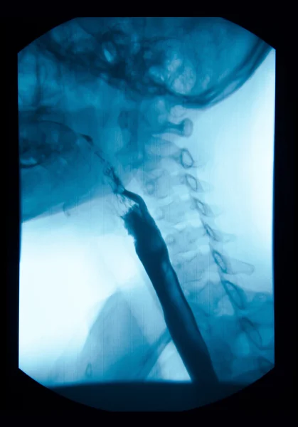 La imagen de la radiografía gastrointestinal superior (UGI), Esofagrama . — Foto de Stock