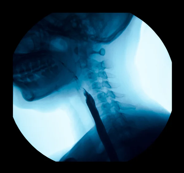 X 線上部消化管ウギ、esophagram の画像. — ストック写真